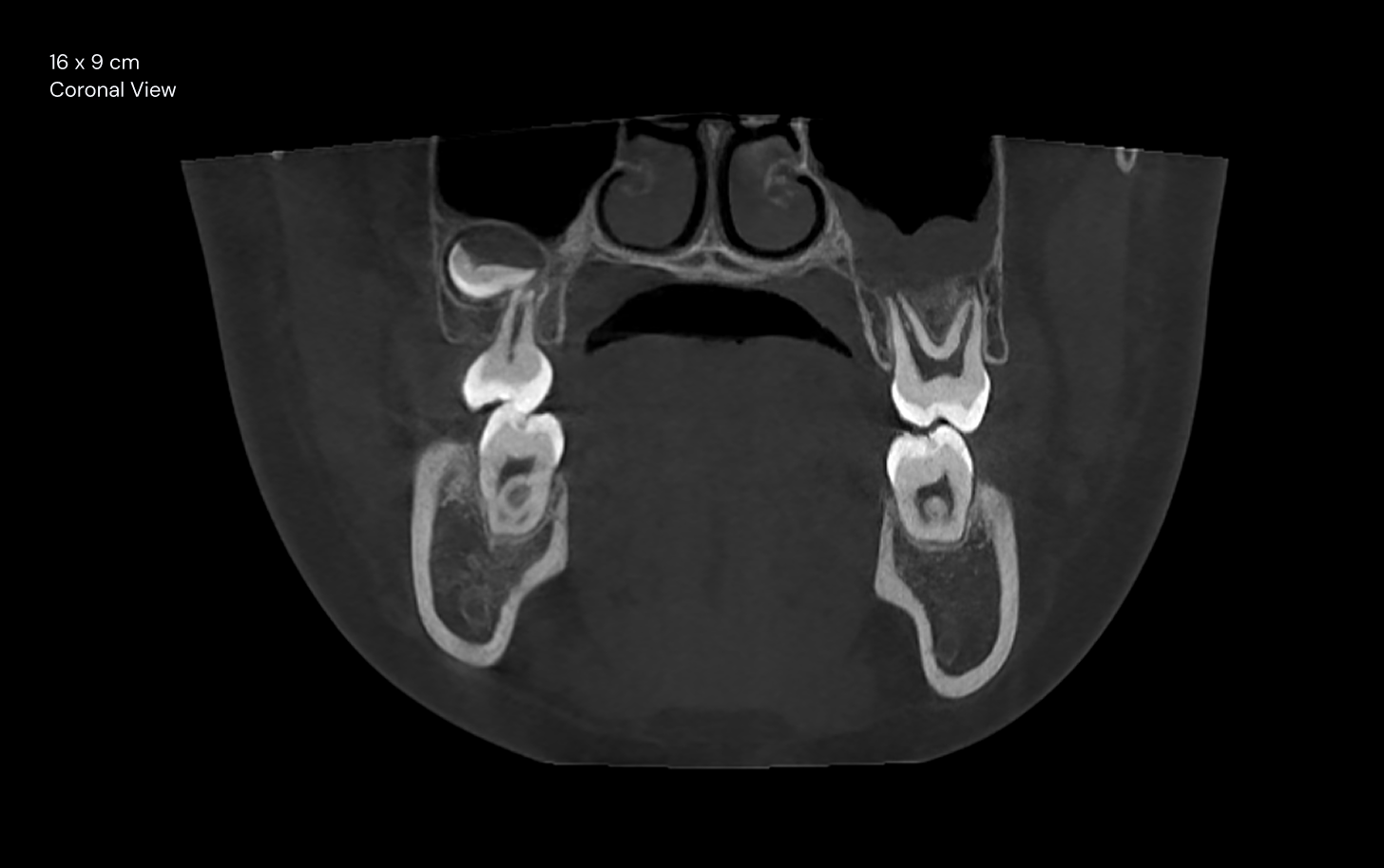 16 x 9 cm Coronal View